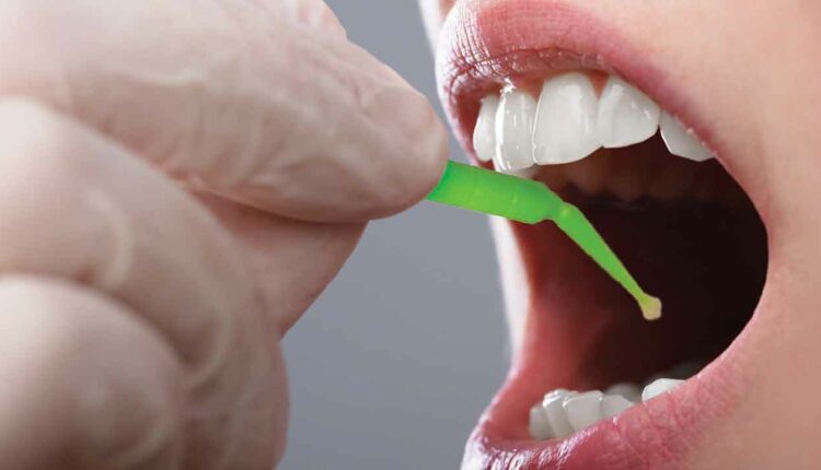Silver Diamine Fluoride SDF in UAE